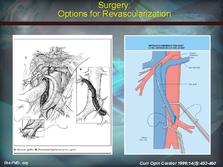 Surgery: Options for Revascularization The PVD. org Curr Opin Cardiol 1999; 14(5): 453 -460