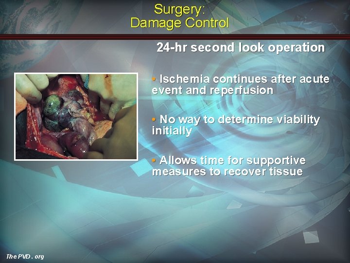 Surgery: Damage Control 24 -hr second look operation • Ischemia continues after acute event