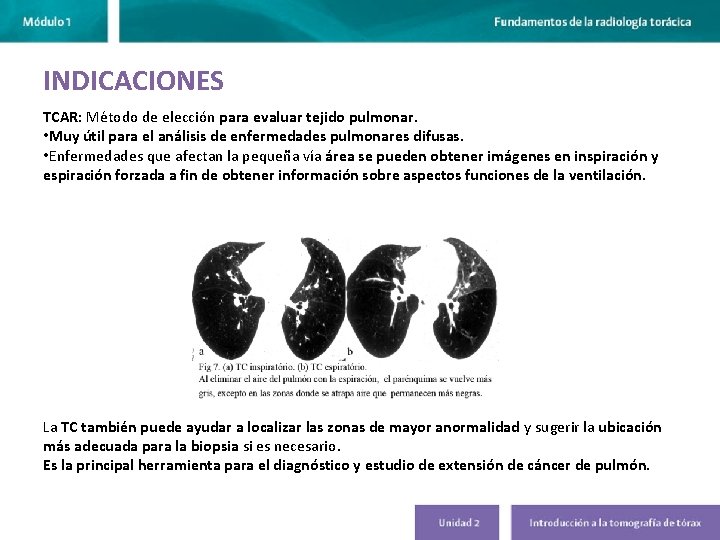 INDICACIONES TCAR: Método de elección para evaluar tejido pulmonar. • Muy útil para el INDICACIONES TCAR: Método de elección para evaluar tejido pulmonar. • Muy útil para el