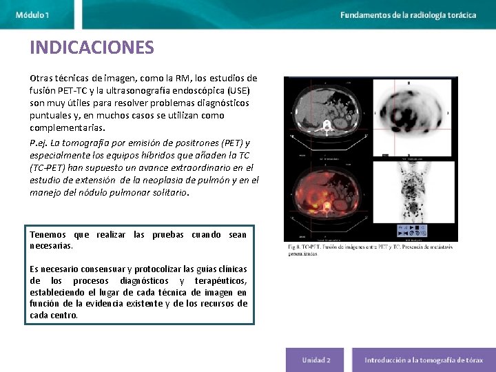 INDICACIONES Otras técnicas de imagen, como la RM, los estudios de fusión PET-TC y INDICACIONES Otras técnicas de imagen, como la RM, los estudios de fusión PET-TC y