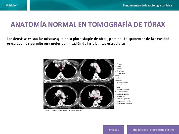 ANATOMÍA NORMAL EN TOMOGRAFÍA DE TÓRAX Las densidades son las mismas que en la ANATOMÍA NORMAL EN TOMOGRAFÍA DE TÓRAX Las densidades son las mismas que en la