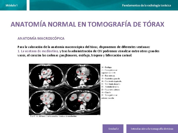 ANATOMÍA NORMAL EN TOMOGRAFÍA DE TÓRAX ANATOMÍA MACROSCÓPICA Para la valoración de la anatomía ANATOMÍA NORMAL EN TOMOGRAFÍA DE TÓRAX ANATOMÍA MACROSCÓPICA Para la valoración de la anatomía