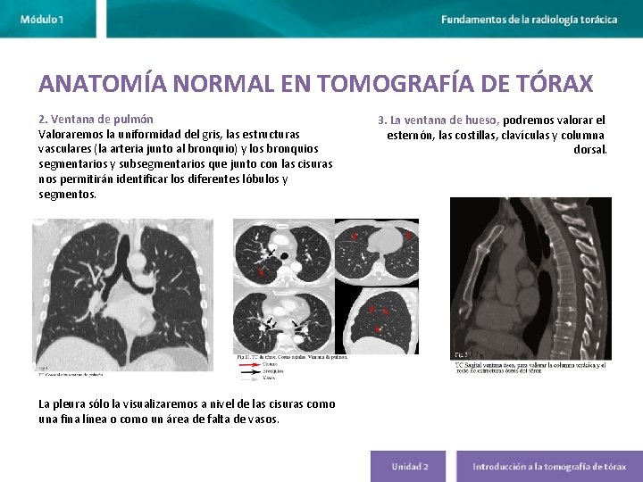 ANATOMÍA NORMAL EN TOMOGRAFÍA DE TÓRAX 2. Ventana de pulmón Valoraremos la uniformidad del ANATOMÍA NORMAL EN TOMOGRAFÍA DE TÓRAX 2. Ventana de pulmón Valoraremos la uniformidad del