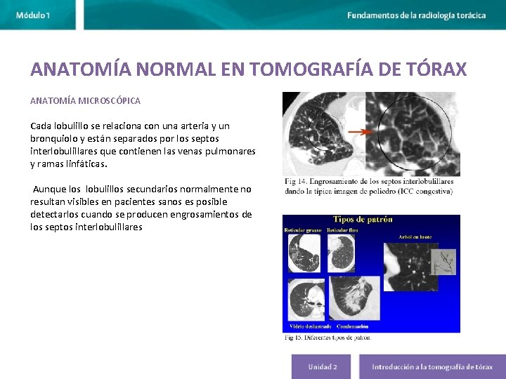 ANATOMÍA NORMAL EN TOMOGRAFÍA DE TÓRAX ANATOMÍA MICROSCÓPICA Cada lobulillo se relaciona con una ANATOMÍA NORMAL EN TOMOGRAFÍA DE TÓRAX ANATOMÍA MICROSCÓPICA Cada lobulillo se relaciona con una
