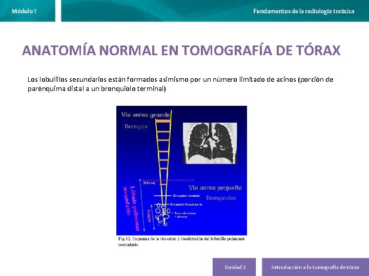 ANATOMÍA NORMAL EN TOMOGRAFÍA DE TÓRAX Los lobulillos secundarios están formados asimismo por un ANATOMÍA NORMAL EN TOMOGRAFÍA DE TÓRAX Los lobulillos secundarios están formados asimismo por un