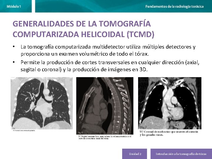 GENERALIDADES DE LA TOMOGRAFÍA COMPUTARIZADA HELICOIDAL (TCMD) • La tomografía computarizada multidetector utiliza múltiples GENERALIDADES DE LA TOMOGRAFÍA COMPUTARIZADA HELICOIDAL (TCMD) • La tomografía computarizada multidetector utiliza múltiples