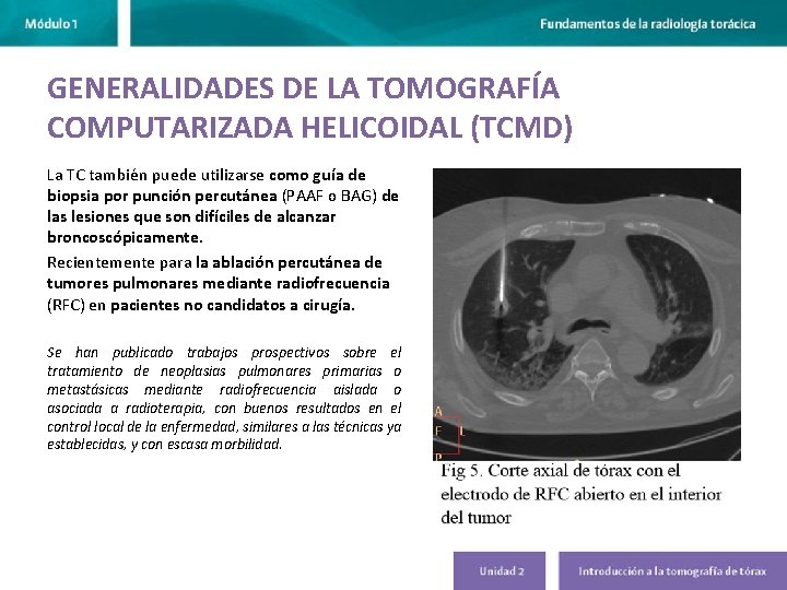 GENERALIDADES DE LA TOMOGRAFÍA COMPUTARIZADA HELICOIDAL (TCMD) La TC también puede utilizarse como guía GENERALIDADES DE LA TOMOGRAFÍA COMPUTARIZADA HELICOIDAL (TCMD) La TC también puede utilizarse como guía