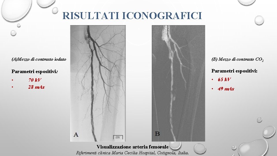 RISULTATI ICONOGRAFICI (A)Mezzo di contrasto iodato (B) Mezzo di contrasto CO 2 Parametri espositivi: