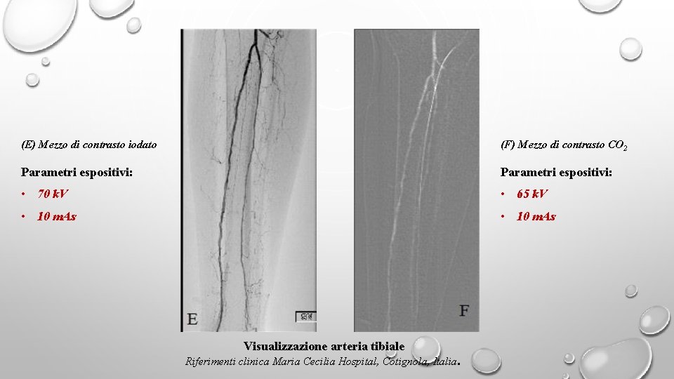 (E) Mezzo di contrasto iodato (F) Mezzo di contrasto CO 2 Parametri espositivi: •