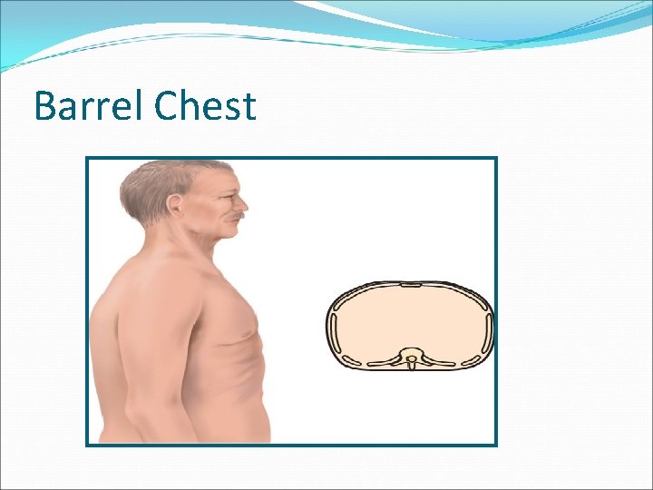 Barrel Chest 