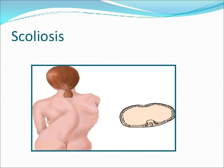 Scoliosis 