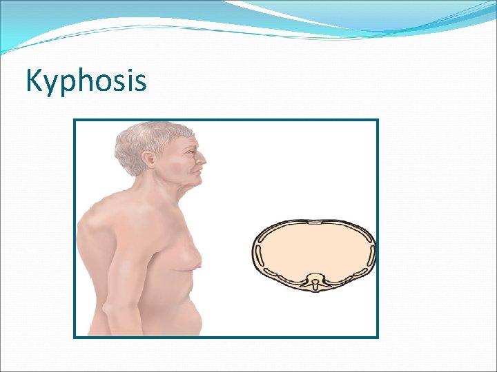 Kyphosis 