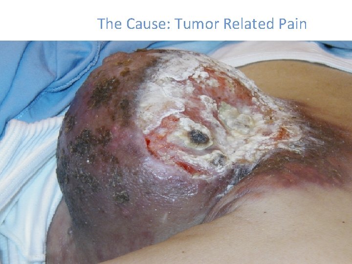 The Cause: Tumor Related Pain 