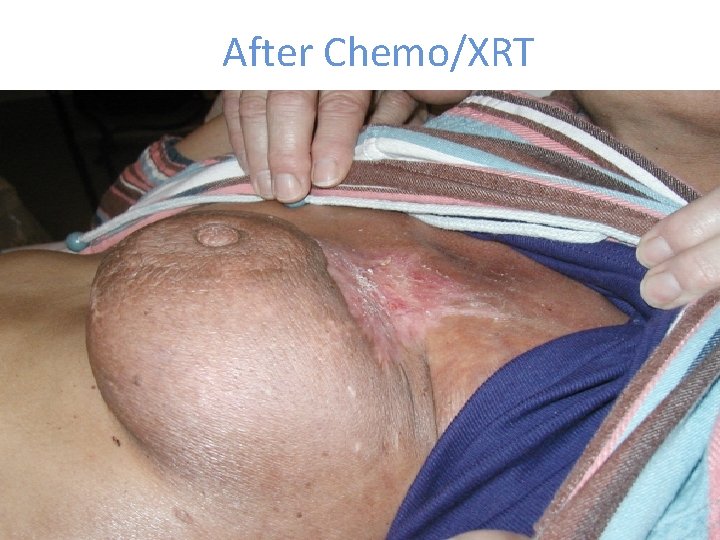 After Chemo/XRT 