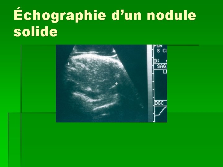 Échographie d’un nodule solide 