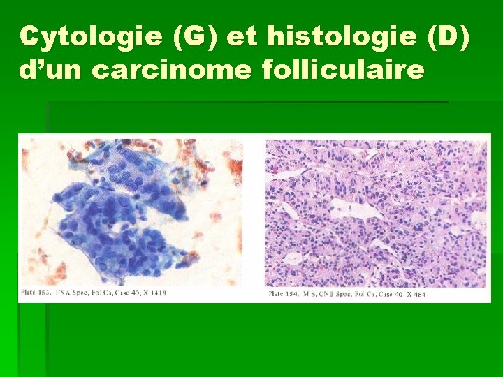 Cytologie (G) et histologie (D) d’un carcinome folliculaire 