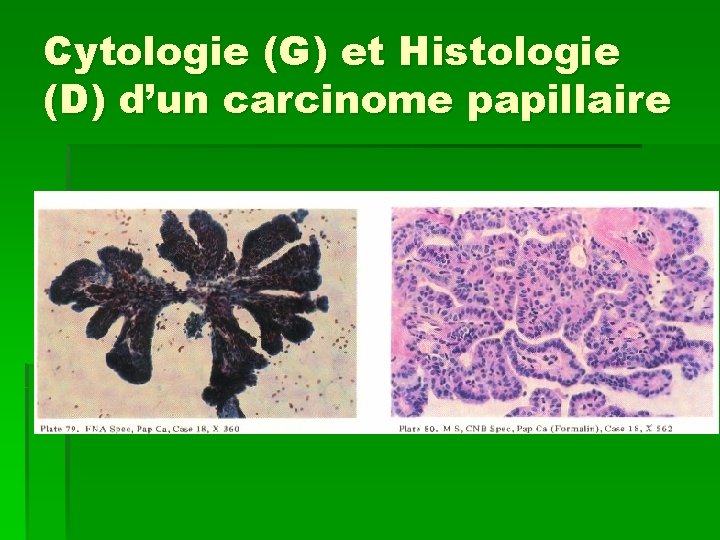 Cytologie (G) et Histologie (D) d’un carcinome papillaire 