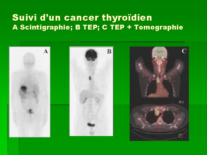 Suivi d’un cancer thyroïdien A Scintigraphie; B TEP; C TEP + Tomographie 