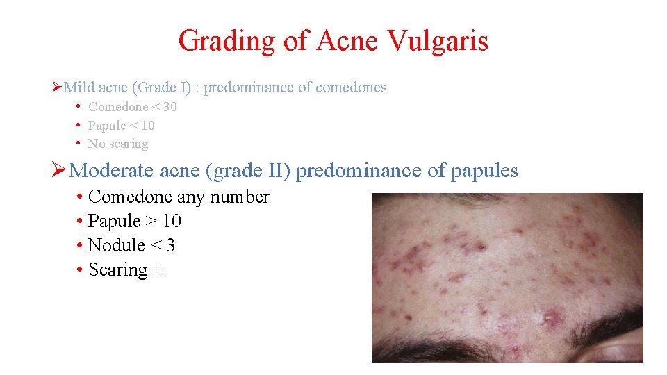 Grading of Acne Vulgaris ØMild acne (Grade I) : predominance of comedones • Comedone