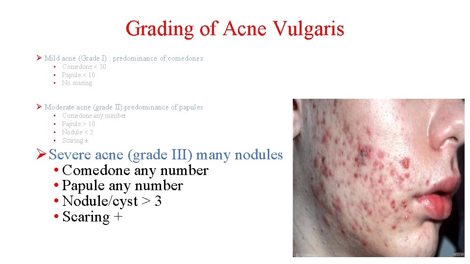 Grading of Acne Vulgaris Ø Mild acne (Grade I) : predominance of comedones •
