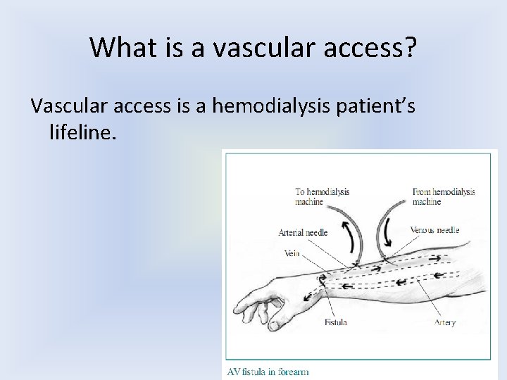 What is a vascular access? Vascular access is a hemodialysis patient’s lifeline. 