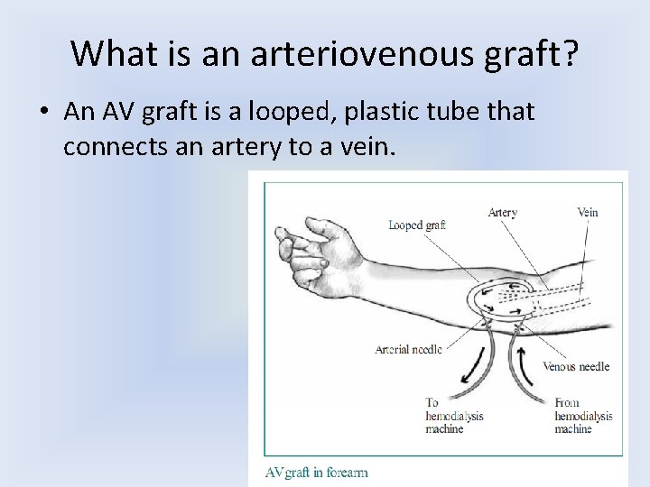 What is an arteriovenous graft? • An AV graft is a looped, plastic tube