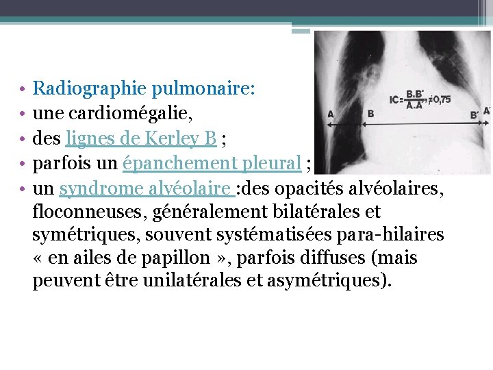 • • • Radiographie pulmonaire: une cardiomégalie, des lignes de Kerley B ; • • • Radiographie pulmonaire: une cardiomégalie, des lignes de Kerley B ;