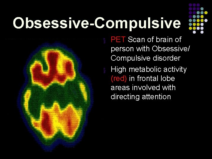 Obsessive-Compulsive § § PET Scan of brain of person with Obsessive/ Compulsive disorder High