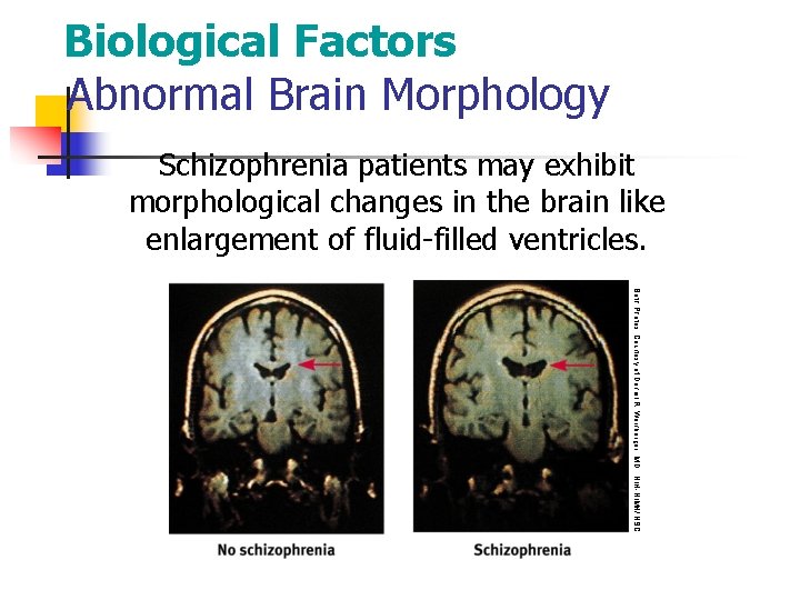 Biological Factors Abnormal Brain Morphology Schizophrenia patients may exhibit morphological changes in the brain