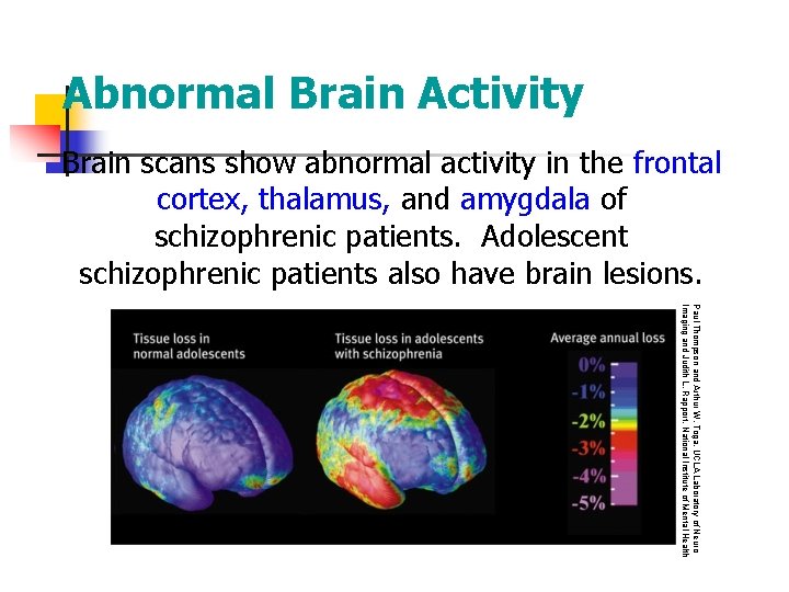 Abnormal Brain Activity Brain scans show abnormal activity in the frontal cortex, thalamus, and