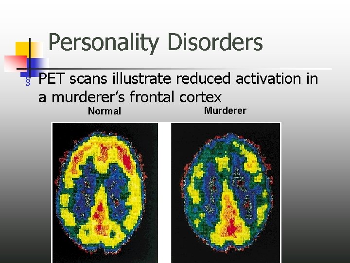 Personality Disorders § PET scans illustrate reduced activation in a murderer’s frontal cortex Normal