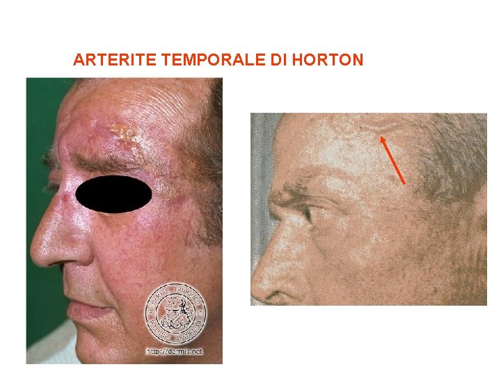 ARTERITE TEMPORALE DI HORTON 