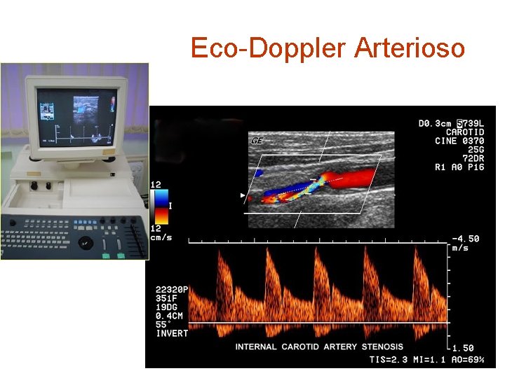 Eco-Doppler Arterioso 