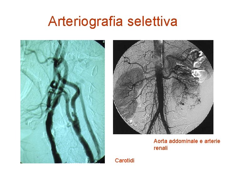 Arteriografia selettiva Aorta addominale e arterie renali Carotidi 