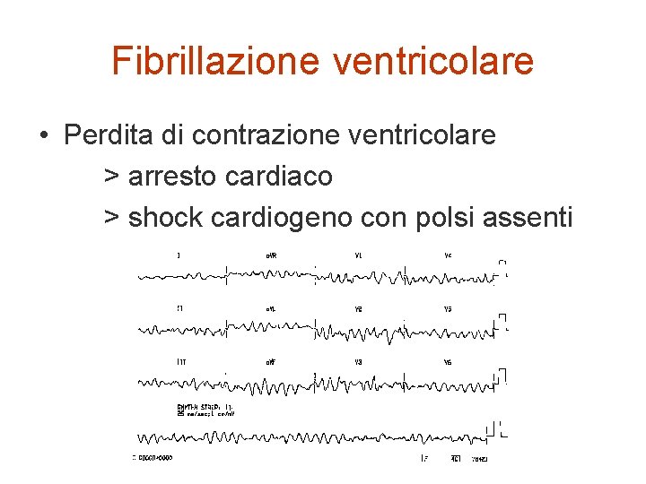 Fibrillazione ventricolare • Perdita di contrazione ventricolare > arresto cardiaco > shock cardiogeno con