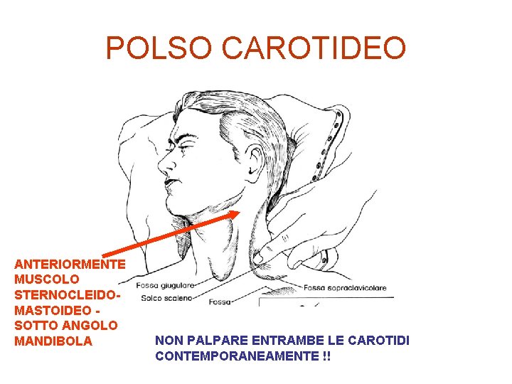 POLSO CAROTIDEO ANTERIORMENTE MUSCOLO STERNOCLEIDOMASTOIDEO SOTTO ANGOLO MANDIBOLA NON PALPARE ENTRAMBE LE CAROTIDI CONTEMPORANEAMENTE