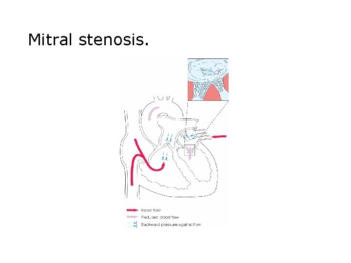 Mitral stenosis. 