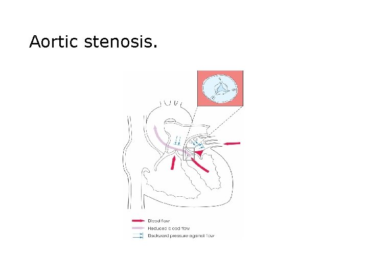 Aortic stenosis. 