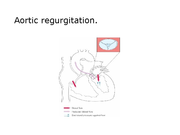 Aortic regurgitation. Aortic regurgitation.