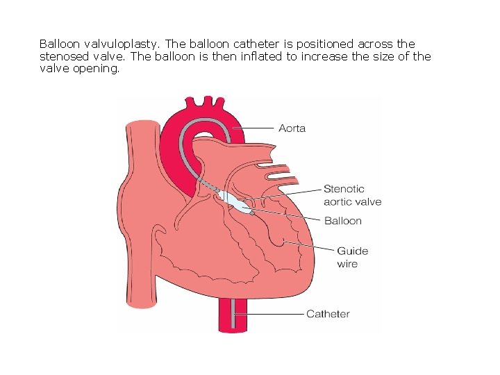 Balloon valvuloplasty. The balloon catheter is positioned across the stenosed valve. The balloon is