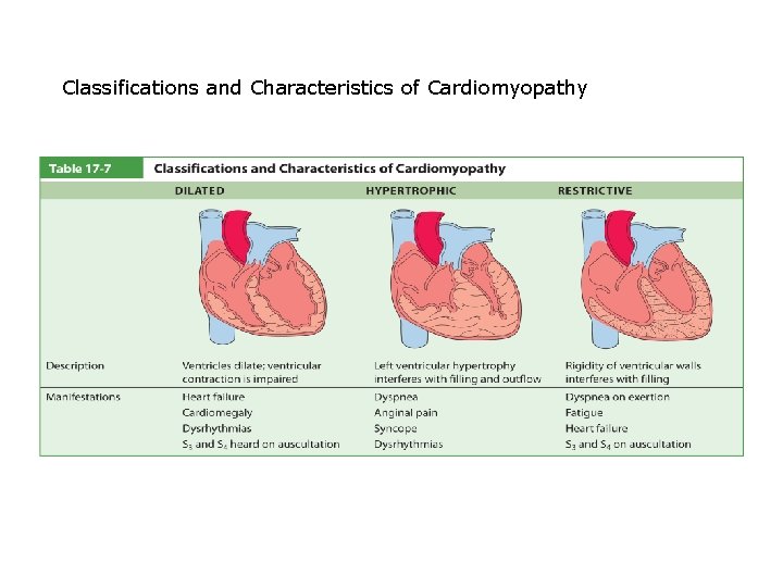 Classifications and Characteristics of Cardiomyopathy 