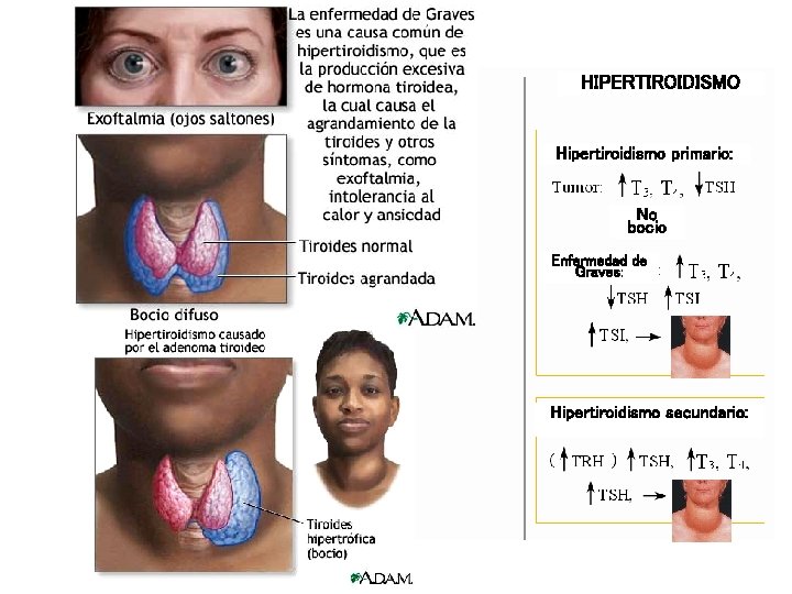 HIPERTIROIDISMO Hipertiroidismo primario: No bocio Enfermedad de Graves: Hipertiroidismo secundario: HIPERTIROIDISMO Hipertiroidismo primario: No bocio Enfermedad de Graves: Hipertiroidismo secundario: