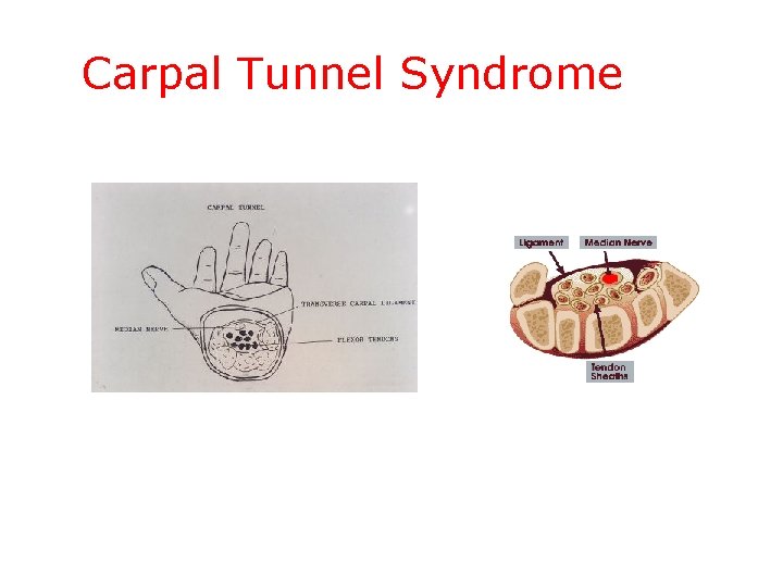 Carpal Tunnel Syndrome 