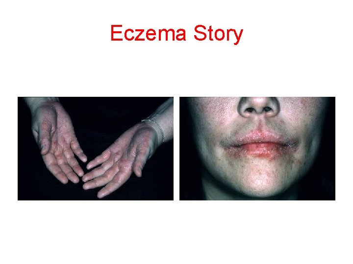 Eczema Story 