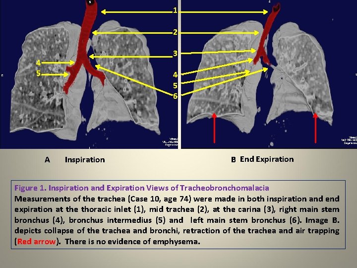 1 2 3 4 5 6 A Inspiration B End Expiration Figure 1. Inspiration