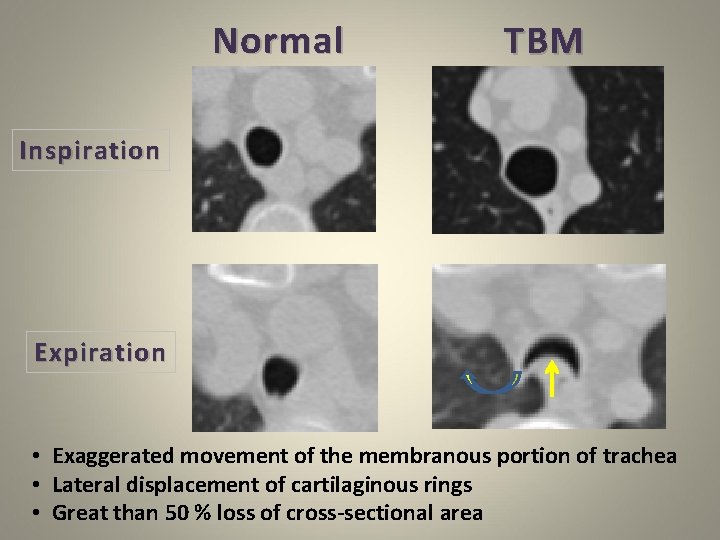 Normal TBM Inspiration Expiration • Exaggerated movement of the membranous portion of trachea •
