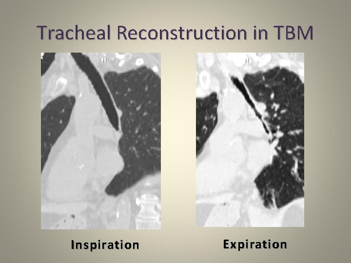 Tracheal Reconstruction in TBM Inspiration Expiration 