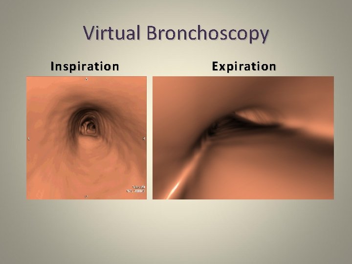 Virtual Bronchoscopy Inspiration Expiration 