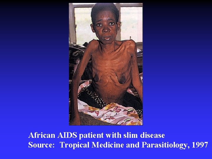 African AIDS patient with slim disease Source: Tropical Medicine and Parasitiology, 1997 