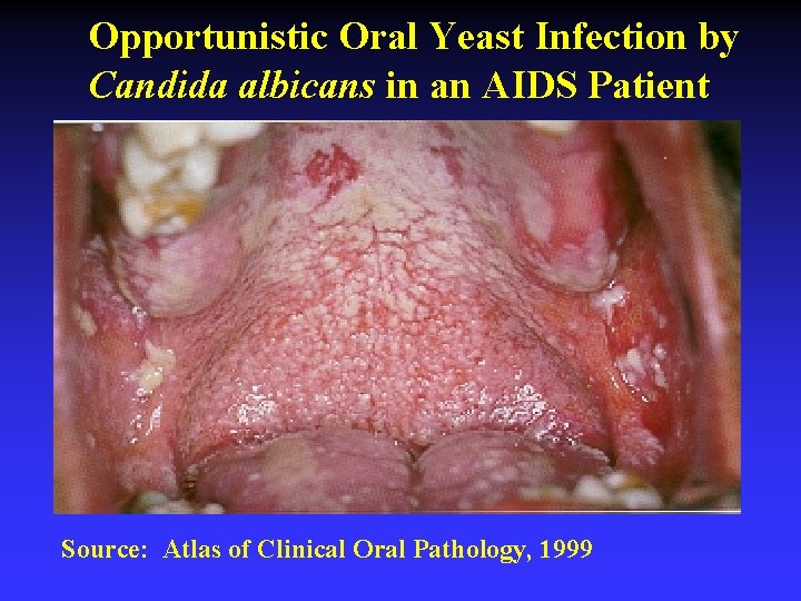 Opportunistic Oral Yeast Infection by Candida albicans in an AIDS Patient Source: Atlas of